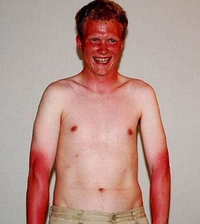 bad_sunburn-other.jpg